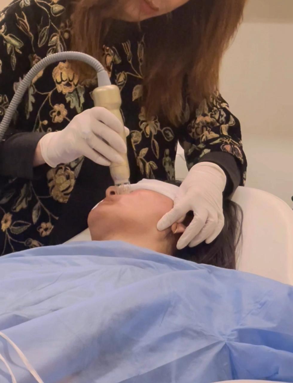 RF Microneedling